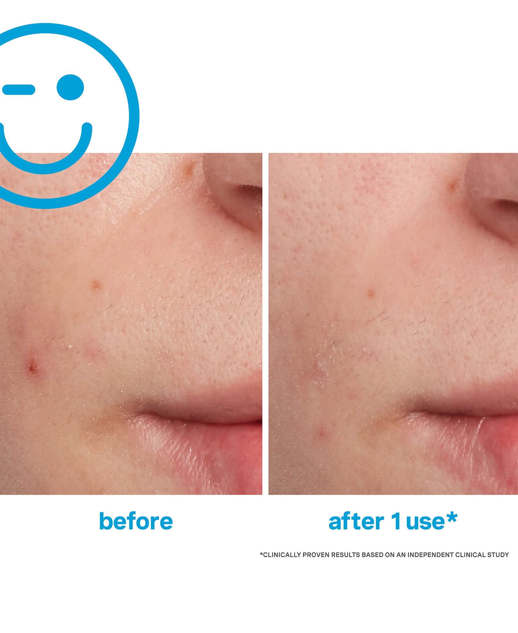 EradiKate Acne Treatment EradiKate Acne Treatment